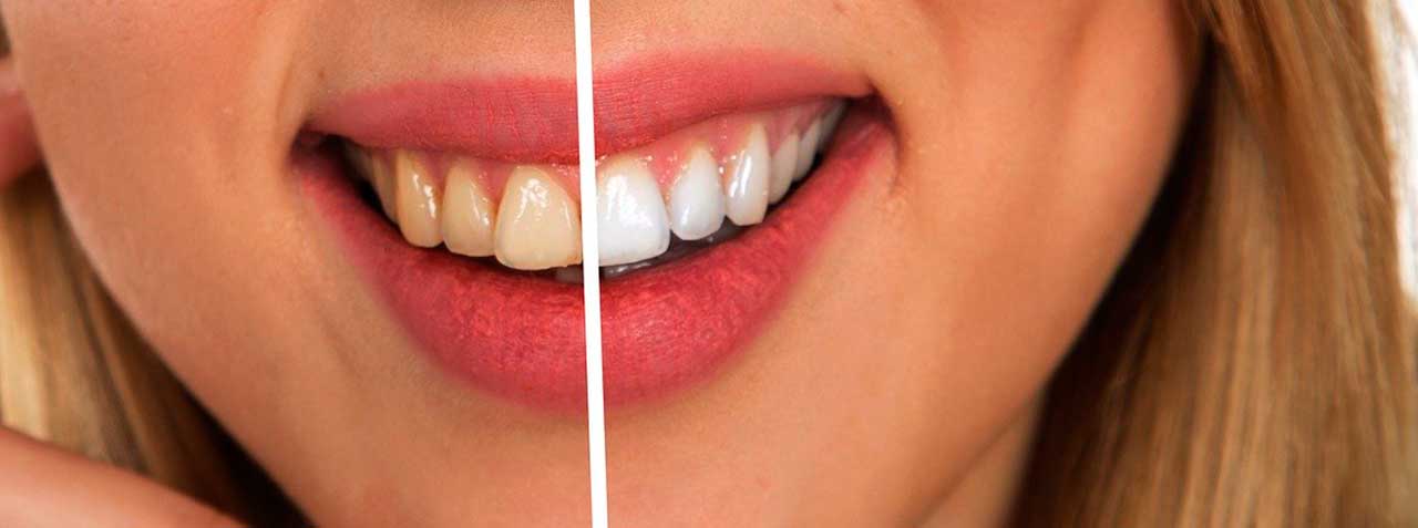 Blanqueamiento Dental Antes Y Después