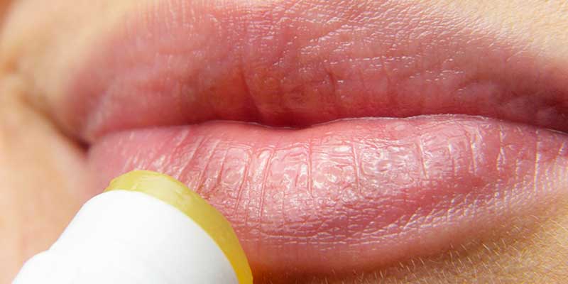 Tratamiento del herpes labial